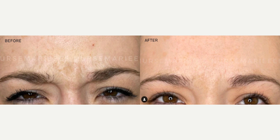 Dysport before and after photo