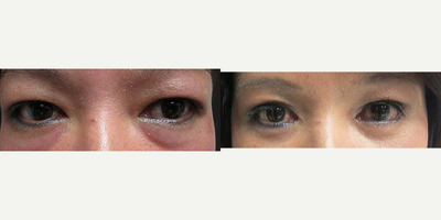 Eyelid Surgery before and after photo