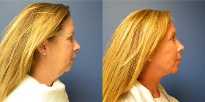 Facelift before and after photo