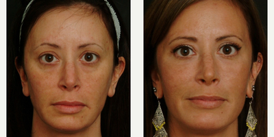 Facial Fat Transfer before and after photo