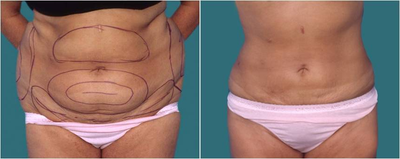Liposuction before and after photo