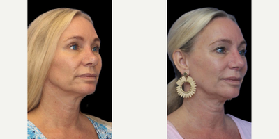 Revision Rhinoplasty before and after photo