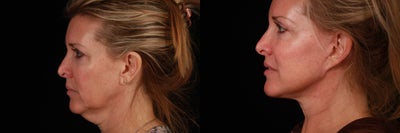 Cheek Lift before and after photo