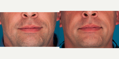 CO2 Laser before and after photo