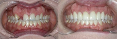 Dental Crown before and after photo