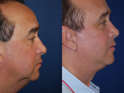 Facelift before and after photo