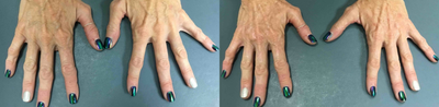 Hand Rejuvenation before and after photo