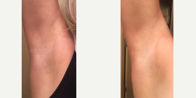 Laser Hair Removal before and after photo