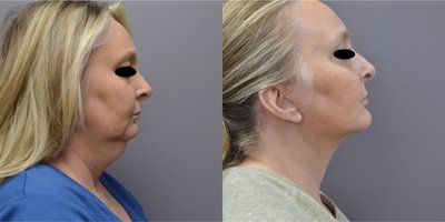 Neck Lift before and after photo