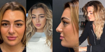 Rhinoplasty before and after photo