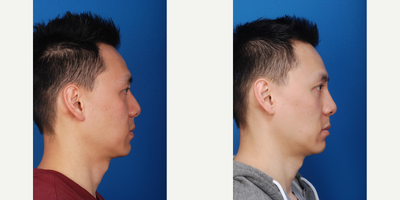 Asian Rhinoplasty before and after photo