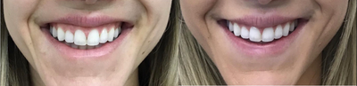Botox before and after photo