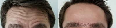 Botox before and after photo