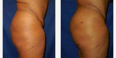 Brazilian Butt Lift before and after photo