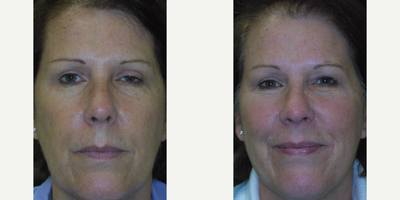 Brow Lift before and after photo