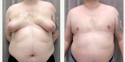 Gynecomastia Surgery before and after photo