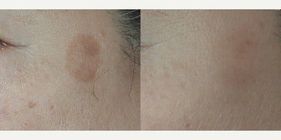 Laser Resurfacing before and after photo