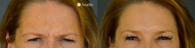 Botox before and after photo