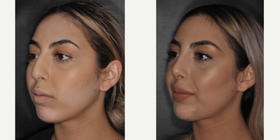 Buccal Fat Removal before and after photo