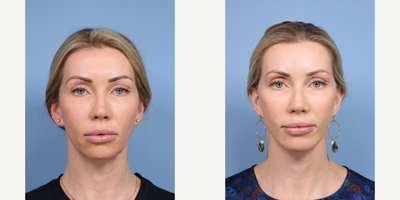 Deep Plane Facelift before and after photo