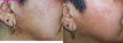 Laser Resurfacing before and after photo