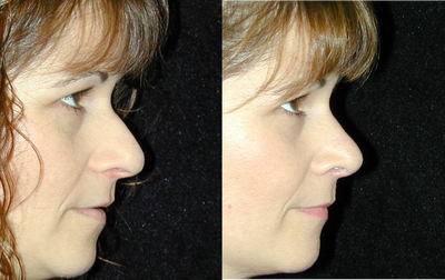 Rhinoplasty before and after photo
