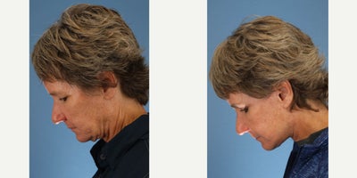 Eyelid Surgery before and after photo