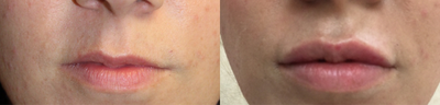 Juvederm before and after photo