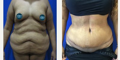 Liposculpture before and after photo