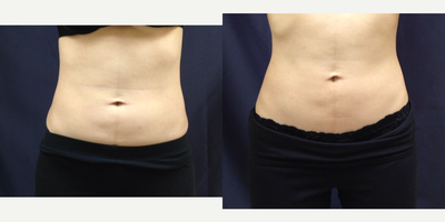 SculpSure before and after photo