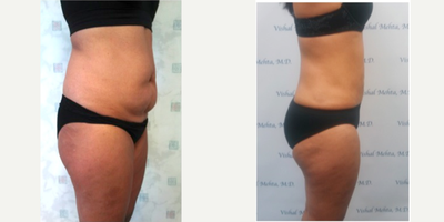 Skin Tightening before and after photo