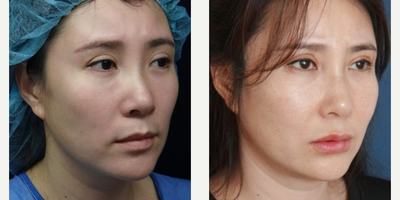 Facelift before and after photo