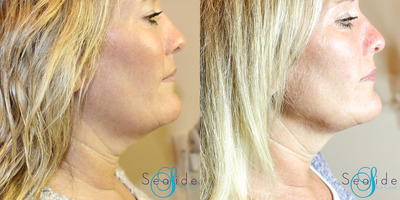 Kybella before and after photo