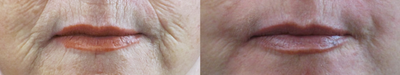 Laser Resurfacing before and after photo