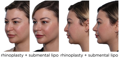 Rhinoplasty before and after photo