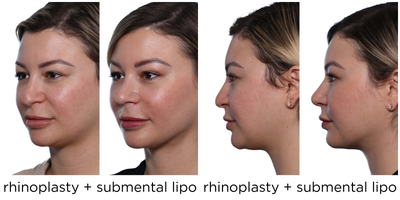 Rhinoplasty before and after photo