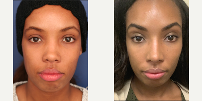 African American Rhinoplasty before and after photo