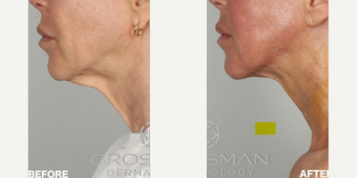 Dermal Fillers before and after photo