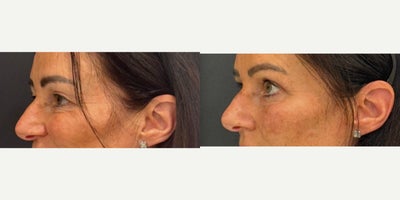 Eyelid Surgery before and after photo