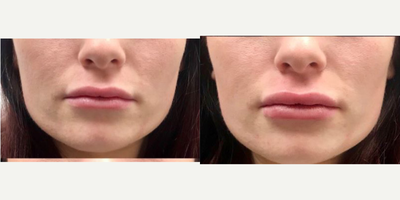 Juvederm before and after photo