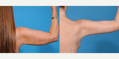 Arm Lift before and after photo