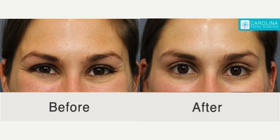Botox before and after photo