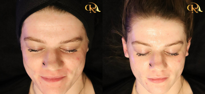 HydraFacial before and after photo
