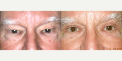 Eyelid Surgery before and after photo