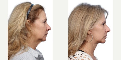 Eyelid Surgery before and after photo