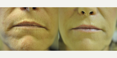 Juvederm before and after photo