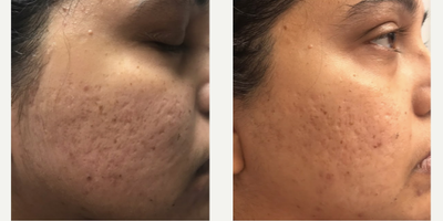 Morpheus8 before and after photo