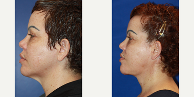 Neck Lift before and after photo