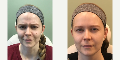 Botox before and after photo
