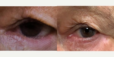 Double Eyelid Surgery before and after photo
